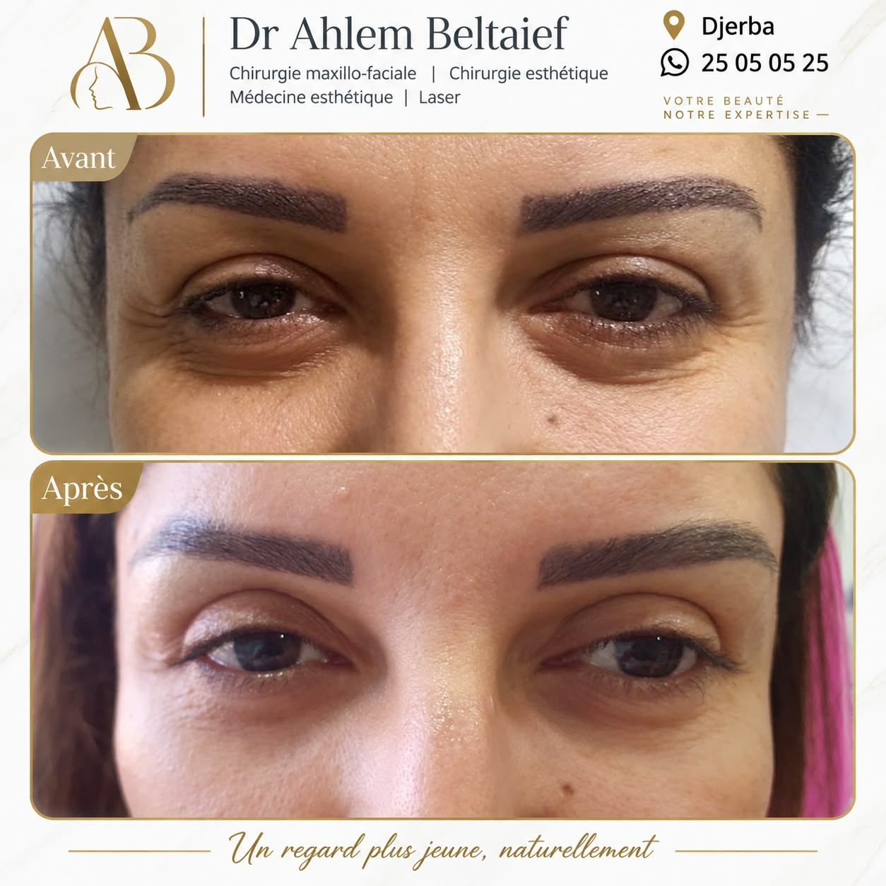 Avant / après blépharoplastie, cas 2