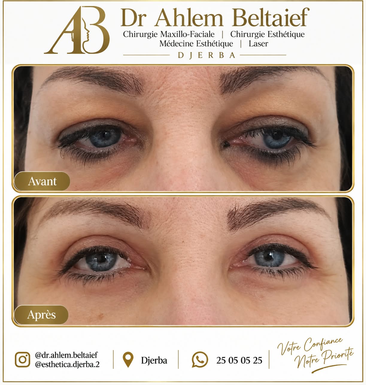 Avant / après blépharoplastie, cas 4