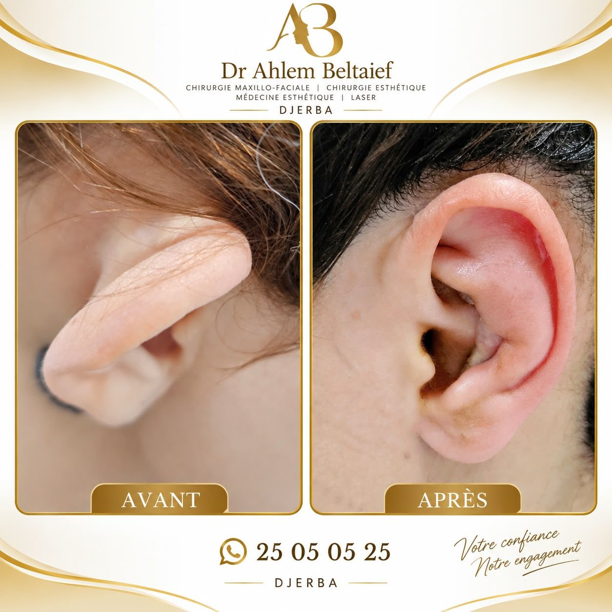 Avant / après otoplastie, cas 3