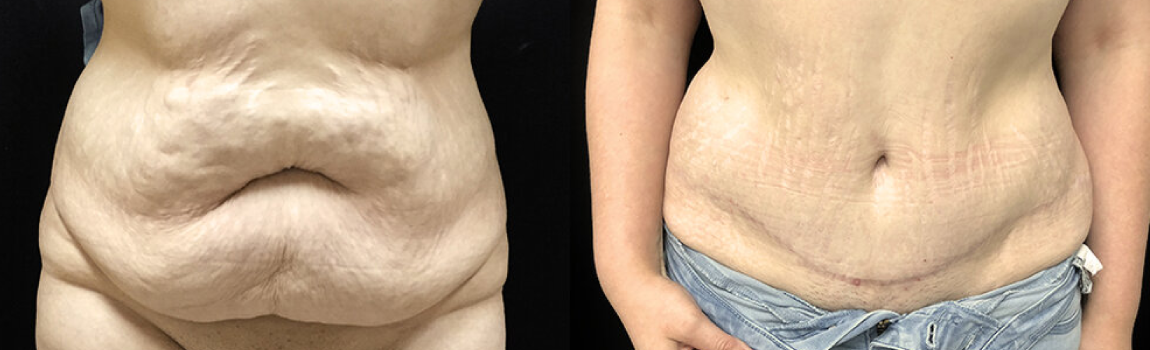 abdominoplastie