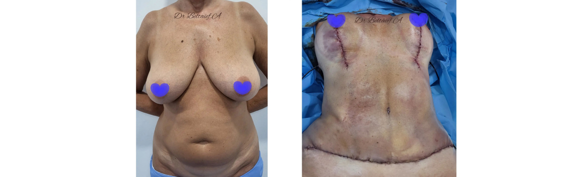 Abdominoplastie