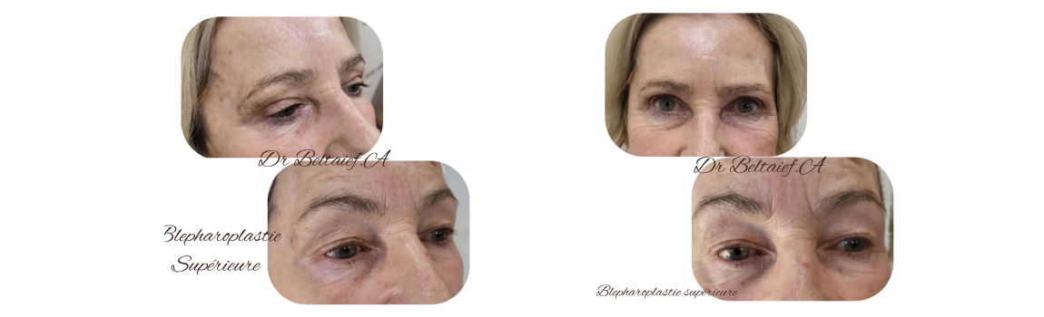 Blepharoplasty