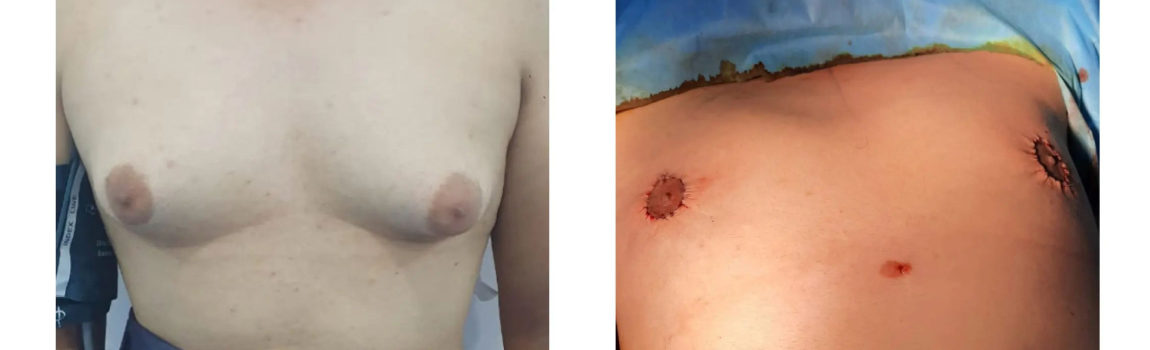 Gynecomastia