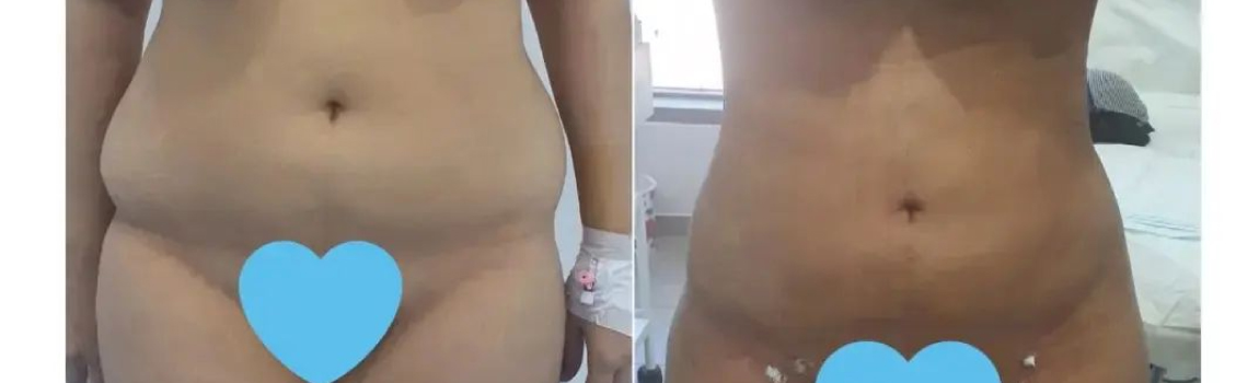 Liposuction