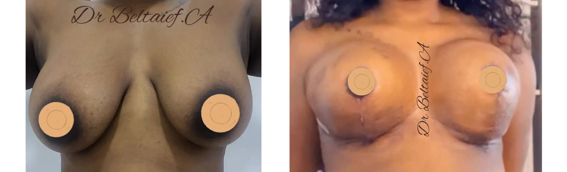 Breast Lift